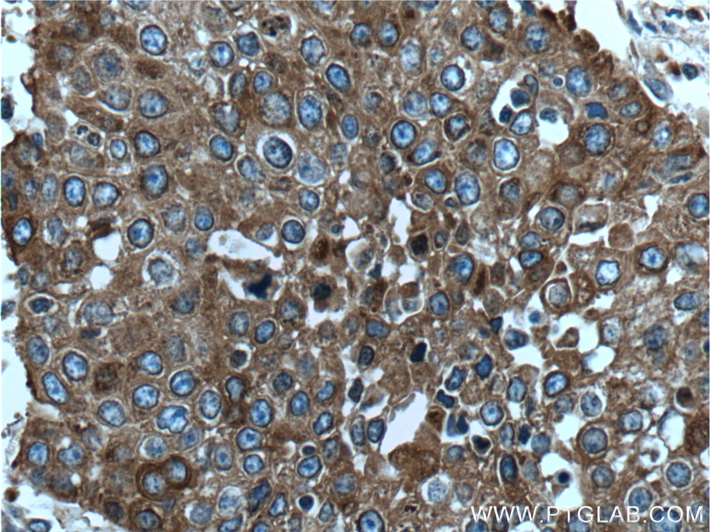 Immunohistochemistry (IHC) staining of human lung cancer tissue using EML4 Polyclonal antibody (22709-1-AP)