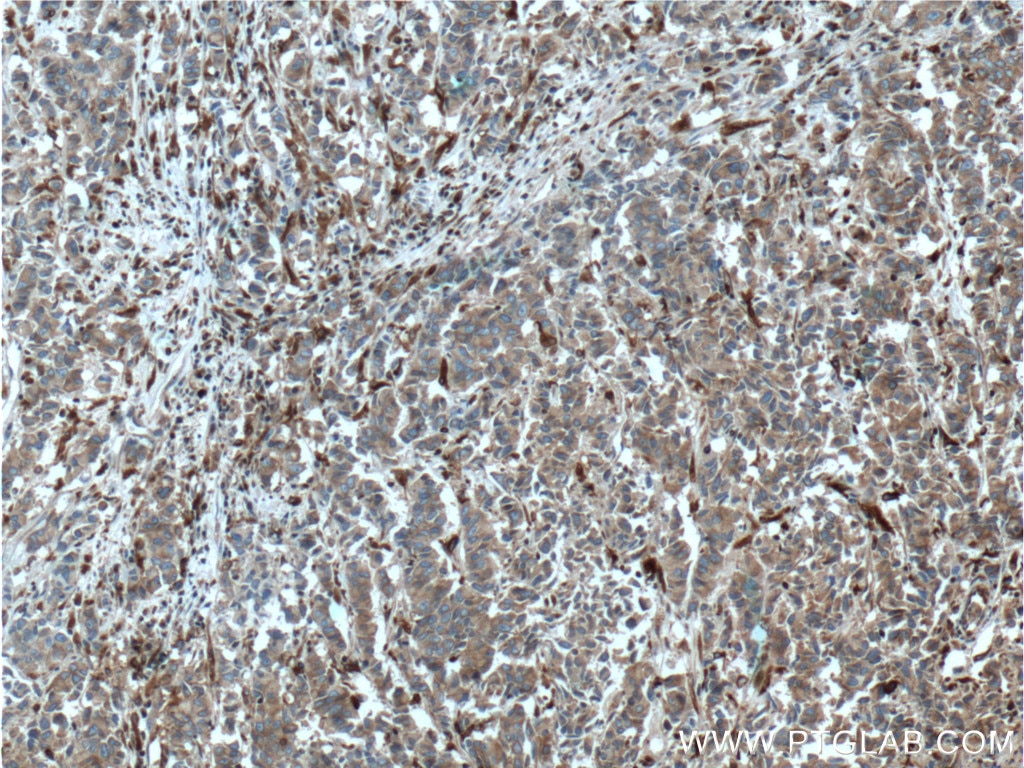 Immunohistochemistry (IHC) staining of human prostate cancer tissue using EML4 Polyclonal antibody (22709-1-AP)