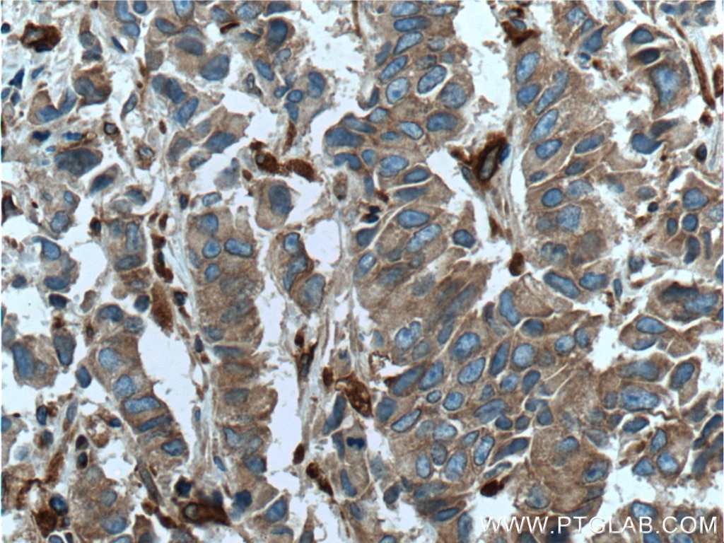 Immunohistochemistry (IHC) staining of human prostate cancer tissue using EML4 Polyclonal antibody (22709-1-AP)