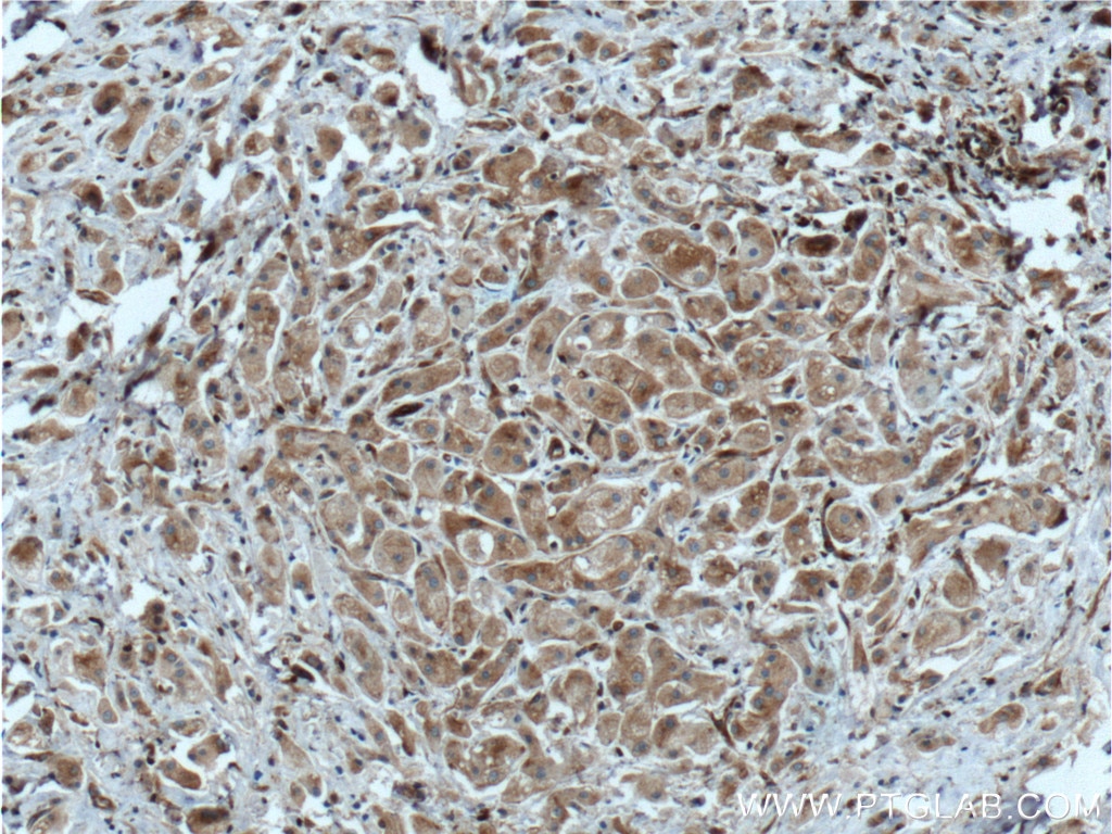 Immunohistochemistry (IHC) staining of human breast cancer tissue using EML4 Polyclonal antibody (22709-1-AP)