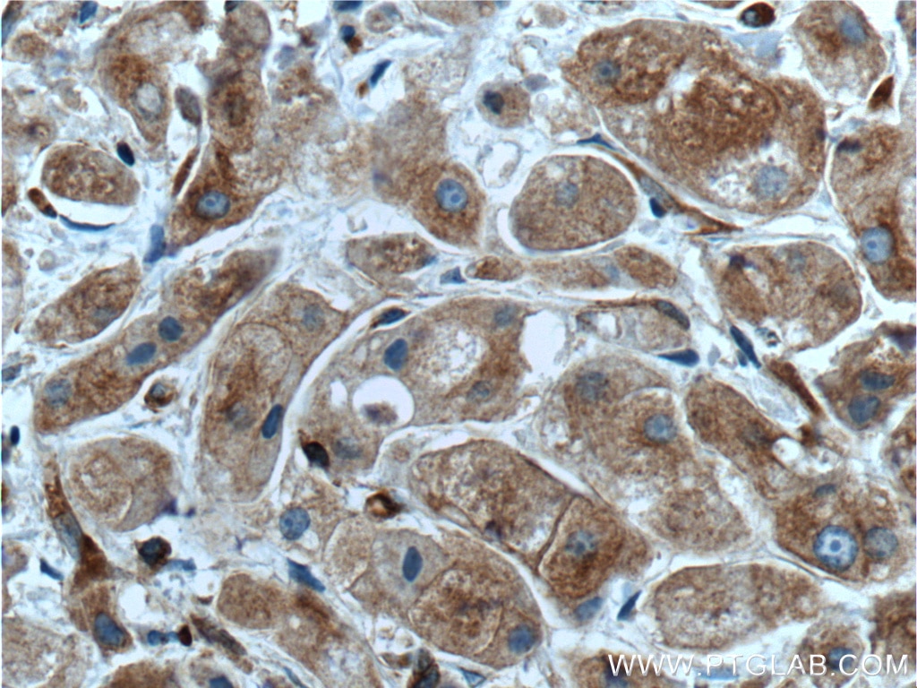 Immunohistochemistry (IHC) staining of human breast cancer tissue using EML4 Polyclonal antibody (22709-1-AP)