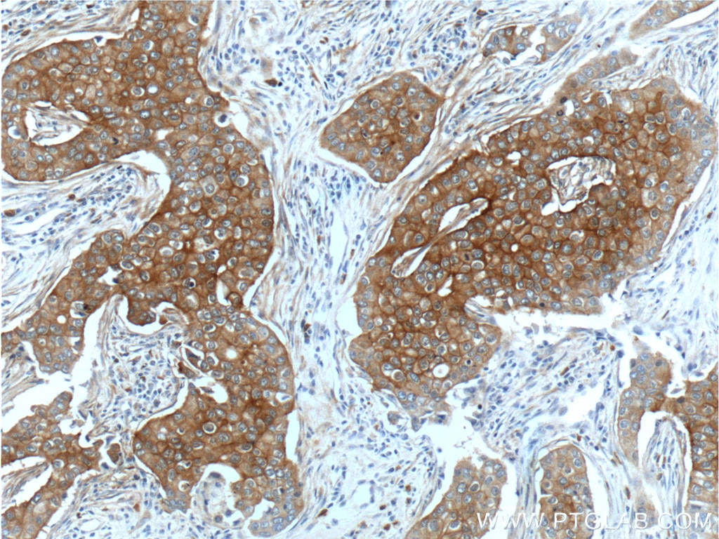 Immunohistochemistry (IHC) staining of human breast cancer tissue using ENAH Polyclonal antibody (26421-1-AP)