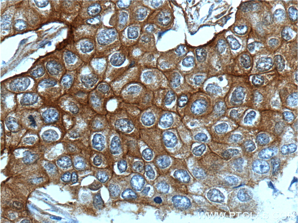 Immunohistochemistry (IHC) staining of human breast cancer tissue using ENAH Polyclonal antibody (26421-1-AP)