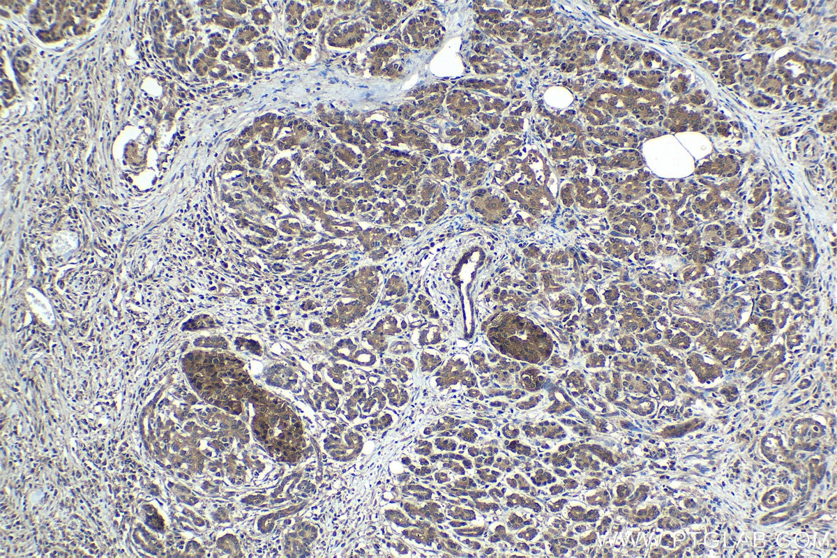Immunohistochemistry (IHC) staining of human pancreas cancer tissue using ENC1 Polyclonal antibody (15007-1-AP)