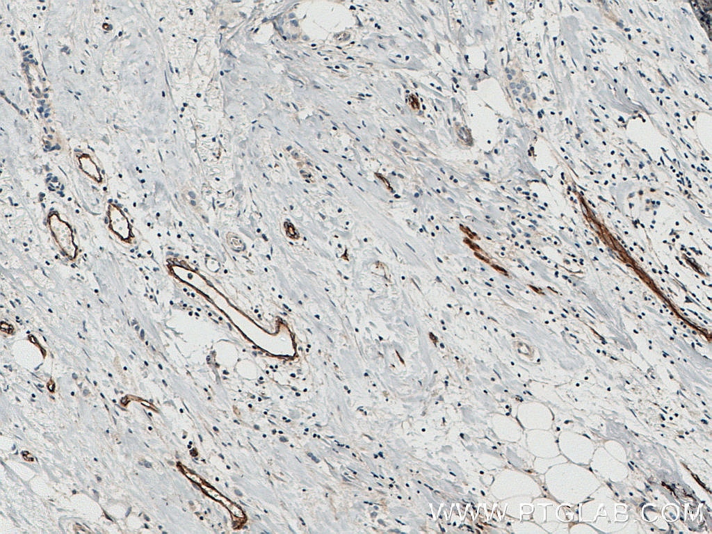 IHC staining of human breast cancer using 10862-1-AP