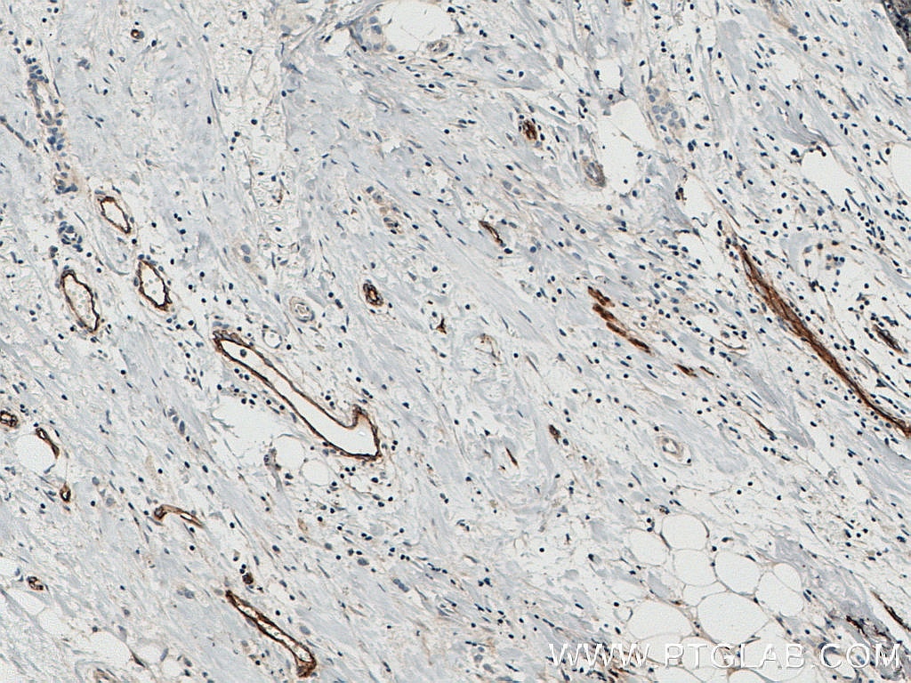 Immunohistochemistry (IHC) staining of human breast cancer tissue using Endoglin/CD105 Polyclonal antibody (10862-1-AP)