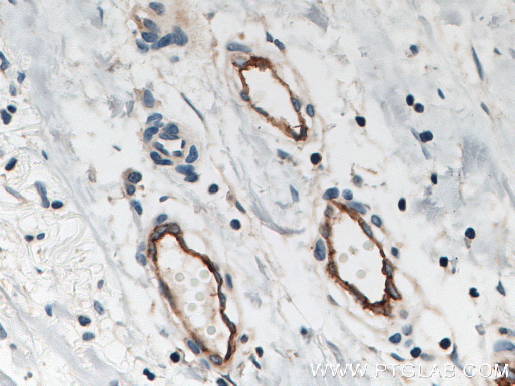 Immunohistochemistry (IHC) staining of human breast cancer tissue using Endoglin/CD105 Polyclonal antibody (10862-1-AP)