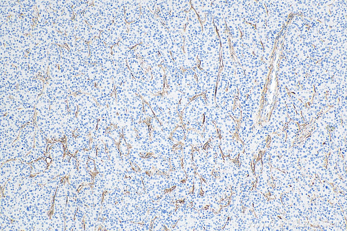 IHC staining of human liver cancer using 10862-1-AP