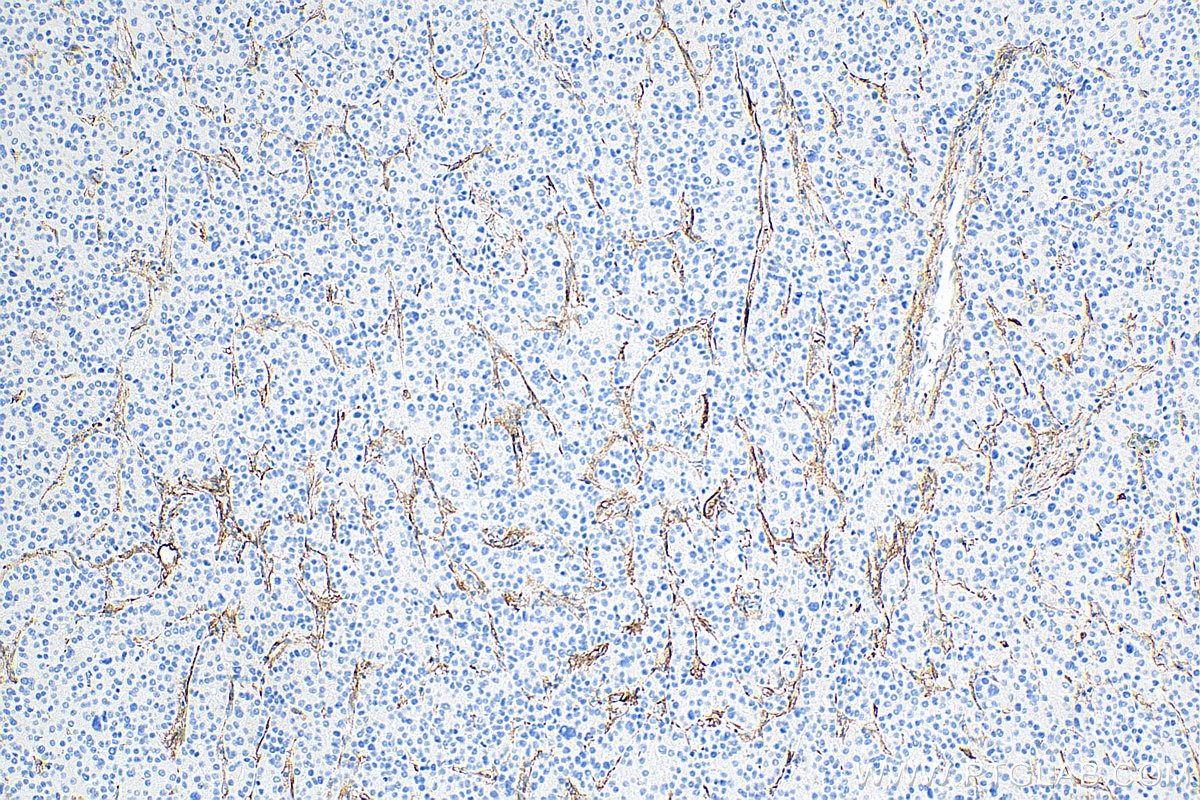 Immunohistochemistry (IHC) staining of human liver cancer tissue using Endoglin/CD105 Polyclonal antibody (10862-1-AP)