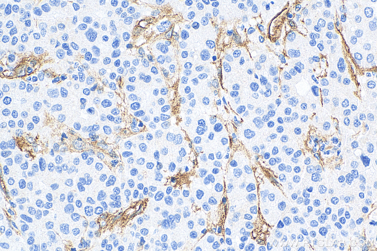 Immunohistochemistry (IHC) staining of human liver cancer tissue using Endoglin/CD105 Polyclonal antibody (10862-1-AP)
