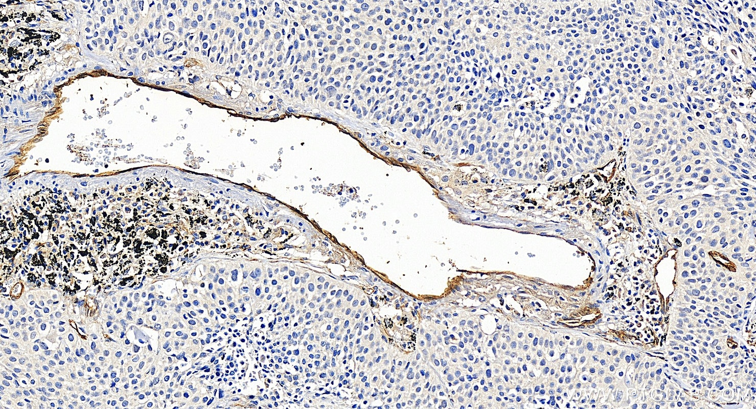 Immunohistochemical analysis of paraffin-embedded human lung cancer tissue slide using 10862-1-AP (Endoglin/CD105 antibody) at dilution of 1:4000 (under 20x lens). Heat mediated antigen retrieval with Tris-EDTA buffer (pH 9.0). Immunohistochemistry (IHC) staining of human lung cancer tissue using Endoglin/CD105 Polyclonal antibody (10862-1-AP)