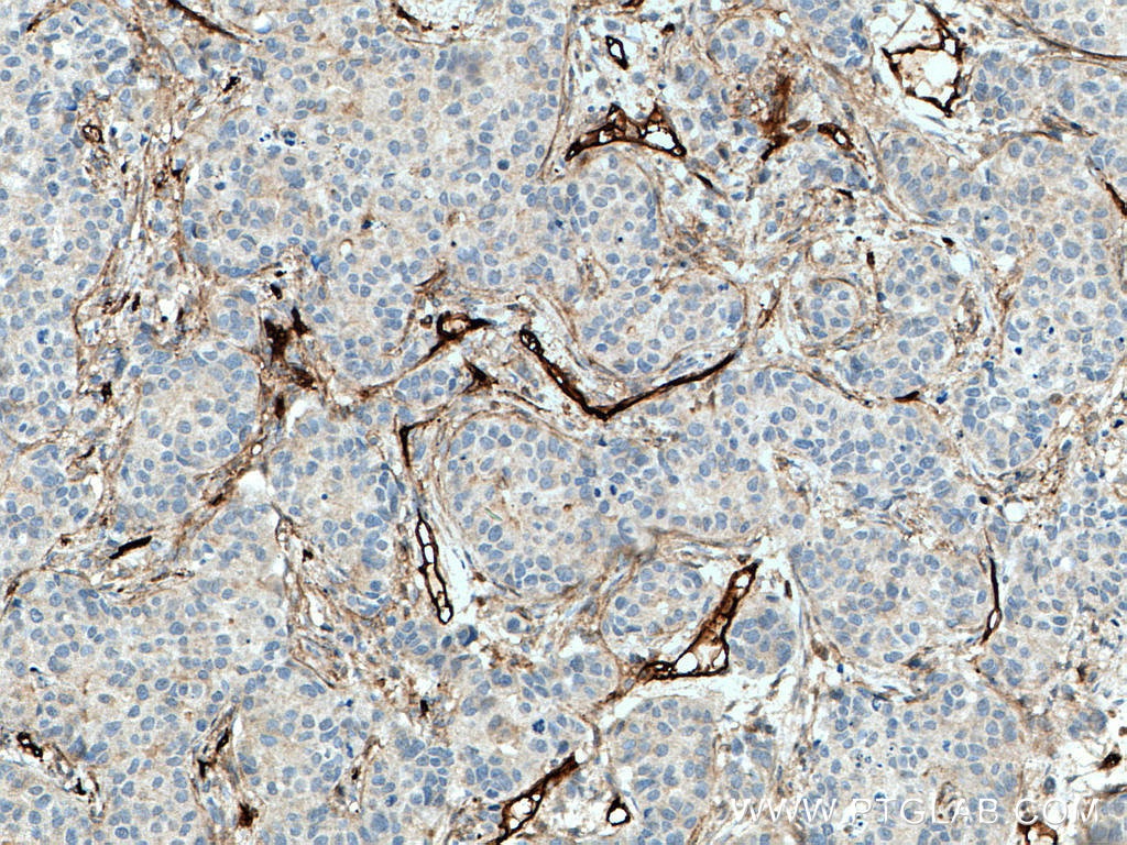 Immunohistochemistry (IHC) staining of human breast cancer tissue using Endoglin/CD105 Polyclonal antibody (28117-1-AP)