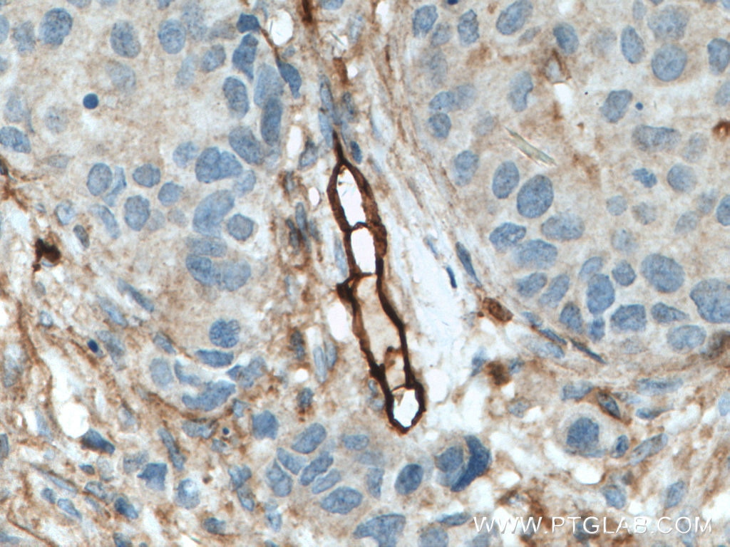 Immunohistochemistry (IHC) staining of human breast cancer tissue using Endoglin/CD105 Polyclonal antibody (28117-1-AP)