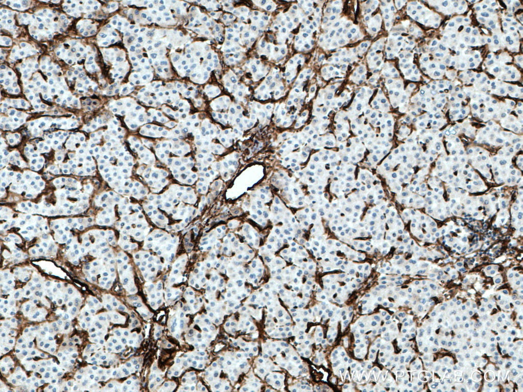 Immunohistochemistry (IHC) staining of human liver cancer tissue using Endoglin/CD105 Polyclonal antibody (28117-1-AP)