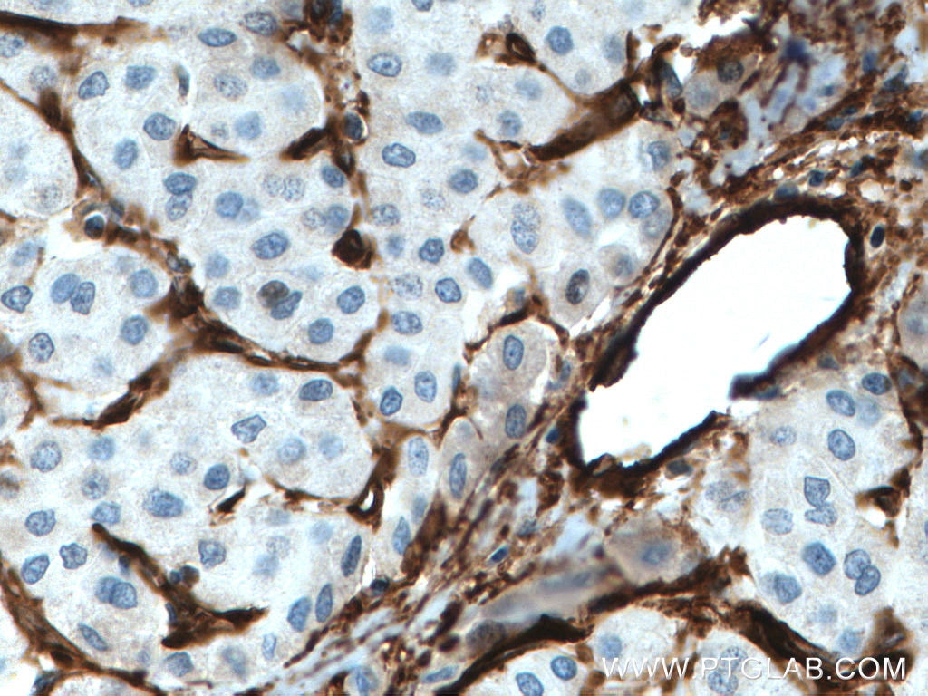 Immunohistochemistry (IHC) staining of human liver cancer tissue using Endoglin/CD105 Polyclonal antibody (28117-1-AP)