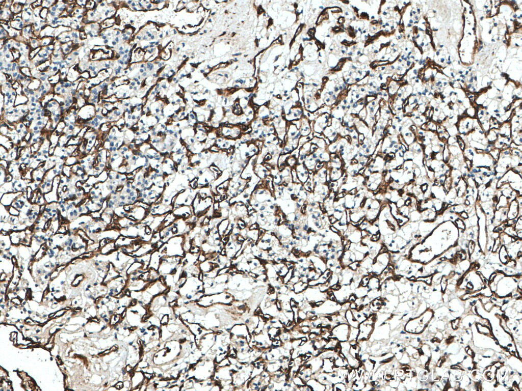 Immunohistochemistry (IHC) staining of human renal cell carcinoma tissue using Endoglin/CD105 Polyclonal antibody (28117-1-AP)