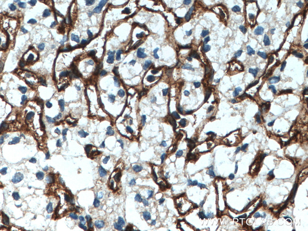 Immunohistochemistry (IHC) staining of human renal cell carcinoma tissue using Endoglin/CD105 Polyclonal antibody (28117-1-AP)