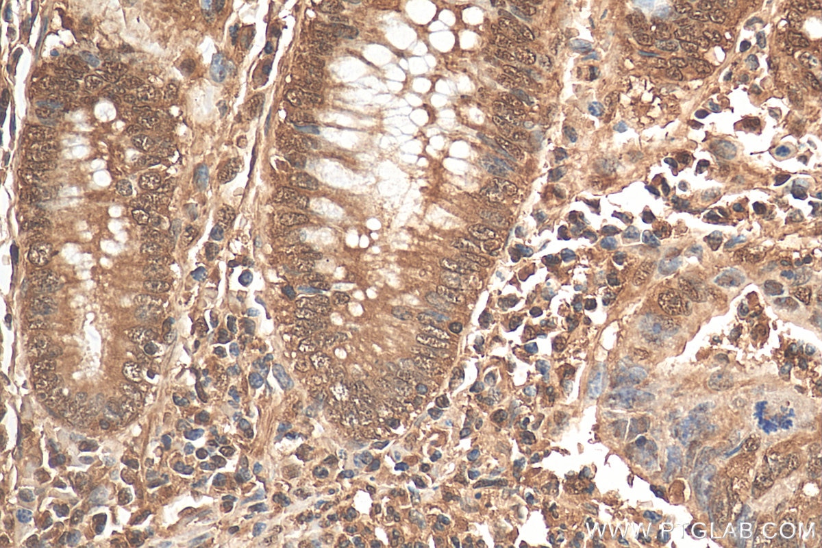 Immunohistochemistry (IHC) staining of human colon cancer tissue using ENO1/2/3 Recombinant antibody (81504-1-RR)