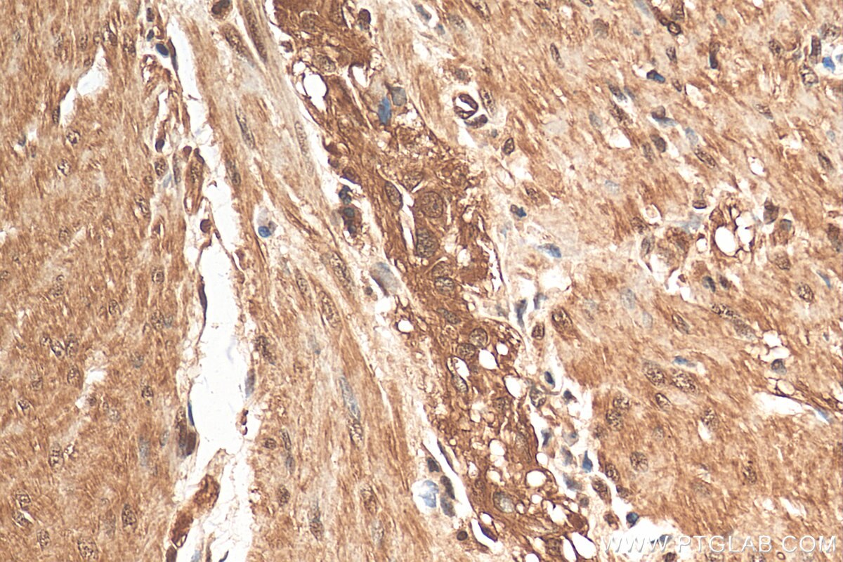 Immunohistochemistry (IHC) staining of human colon cancer tissue using ENO1/2/3 Recombinant antibody (81504-1-RR)