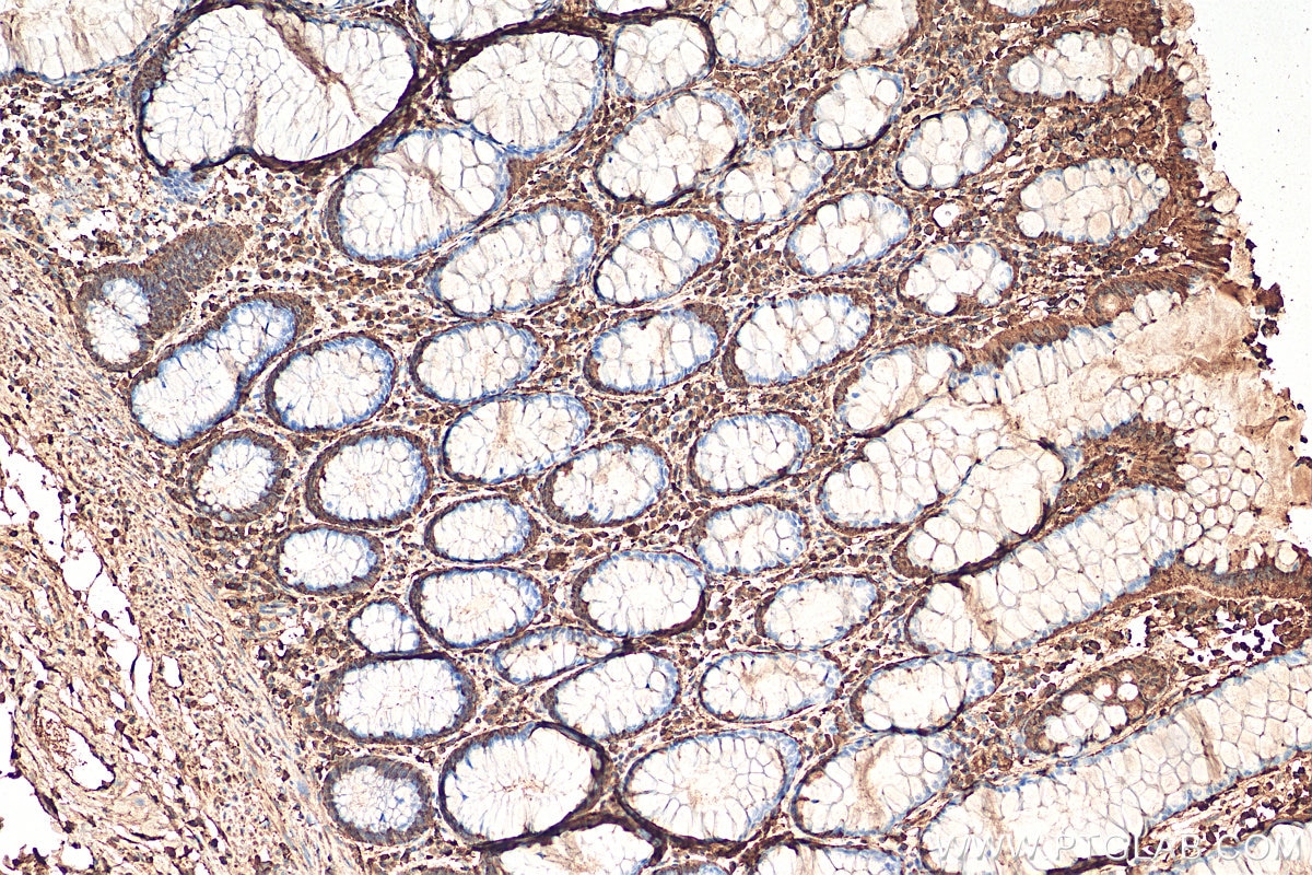 Immunohistochemistry (IHC) staining of human colon cancer tissue using ENO1 Polyclonal antibody (11204-1-AP)