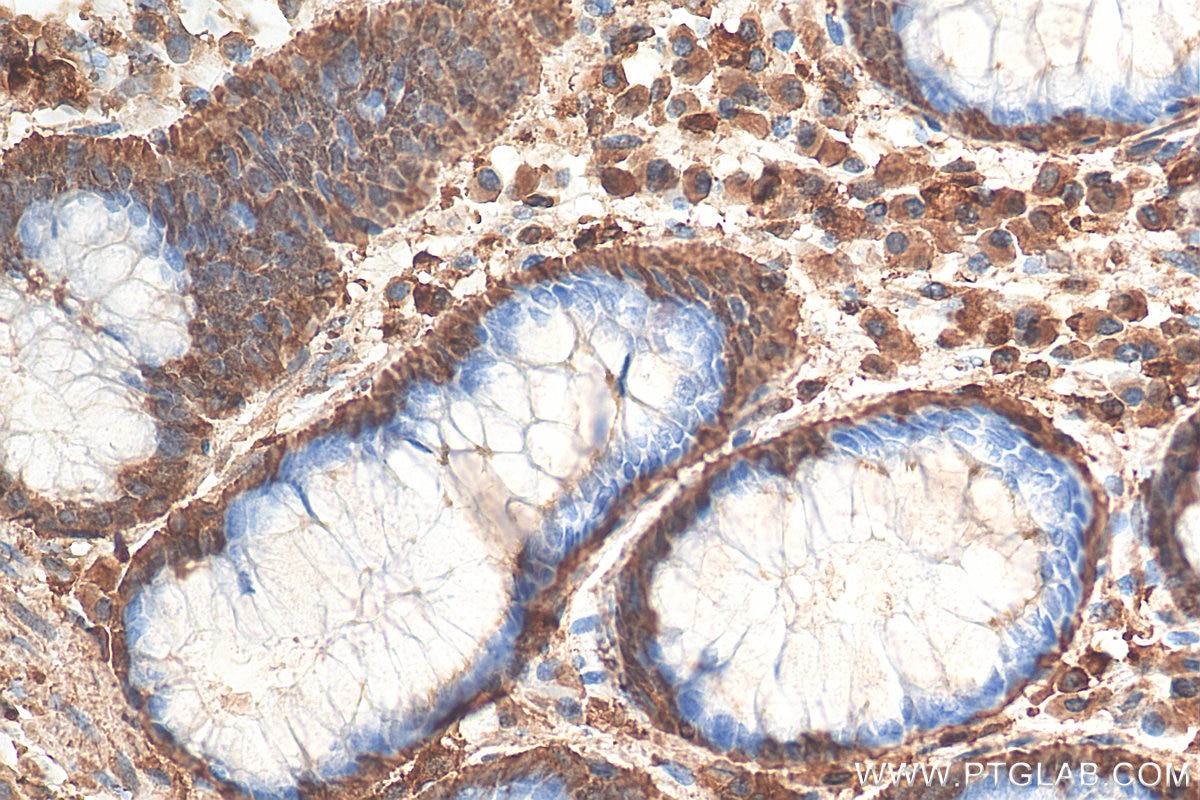 IHC staining of human colon cancer using 11204-1-AP