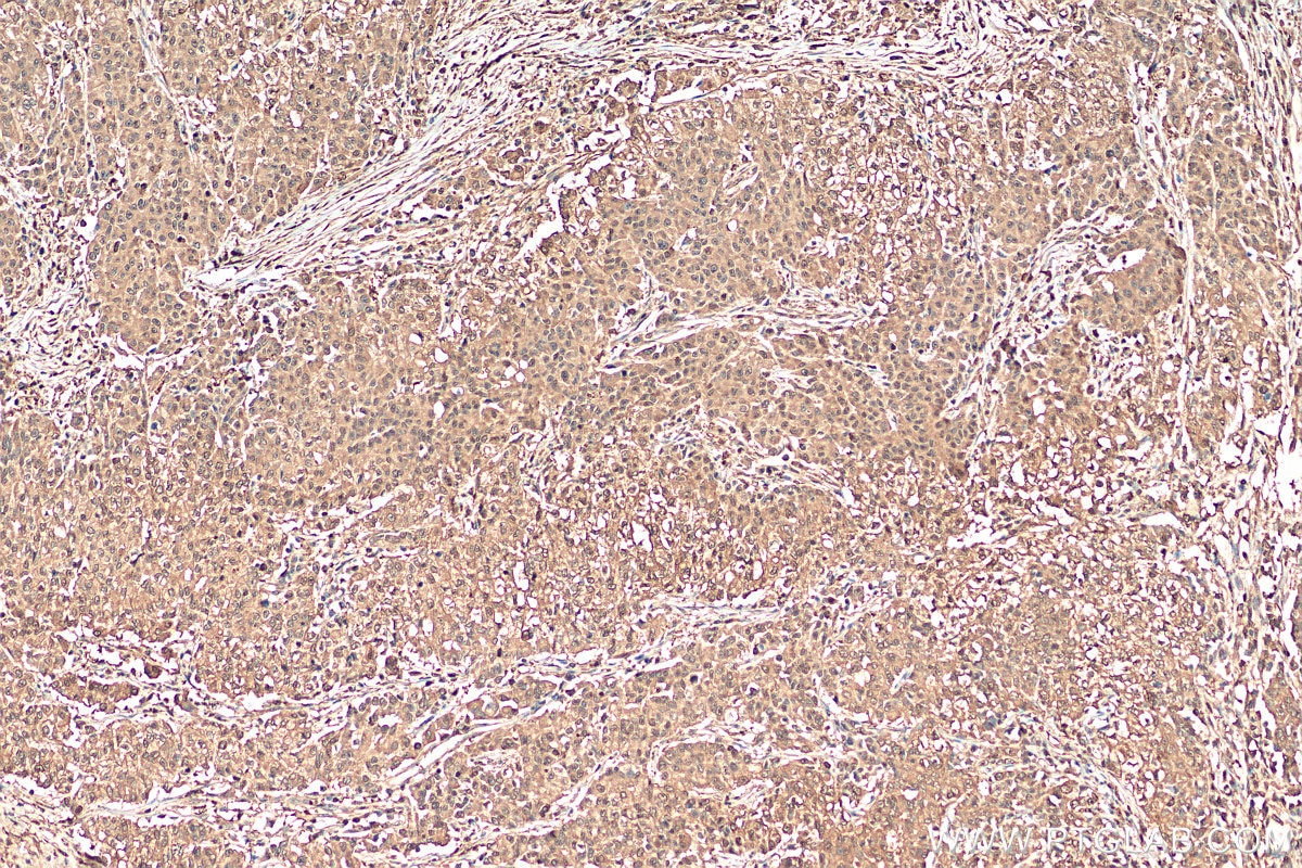 Immunohistochemistry (IHC) staining of human stomach cancer tissue using ENO1 Polyclonal antibody (11204-1-AP)