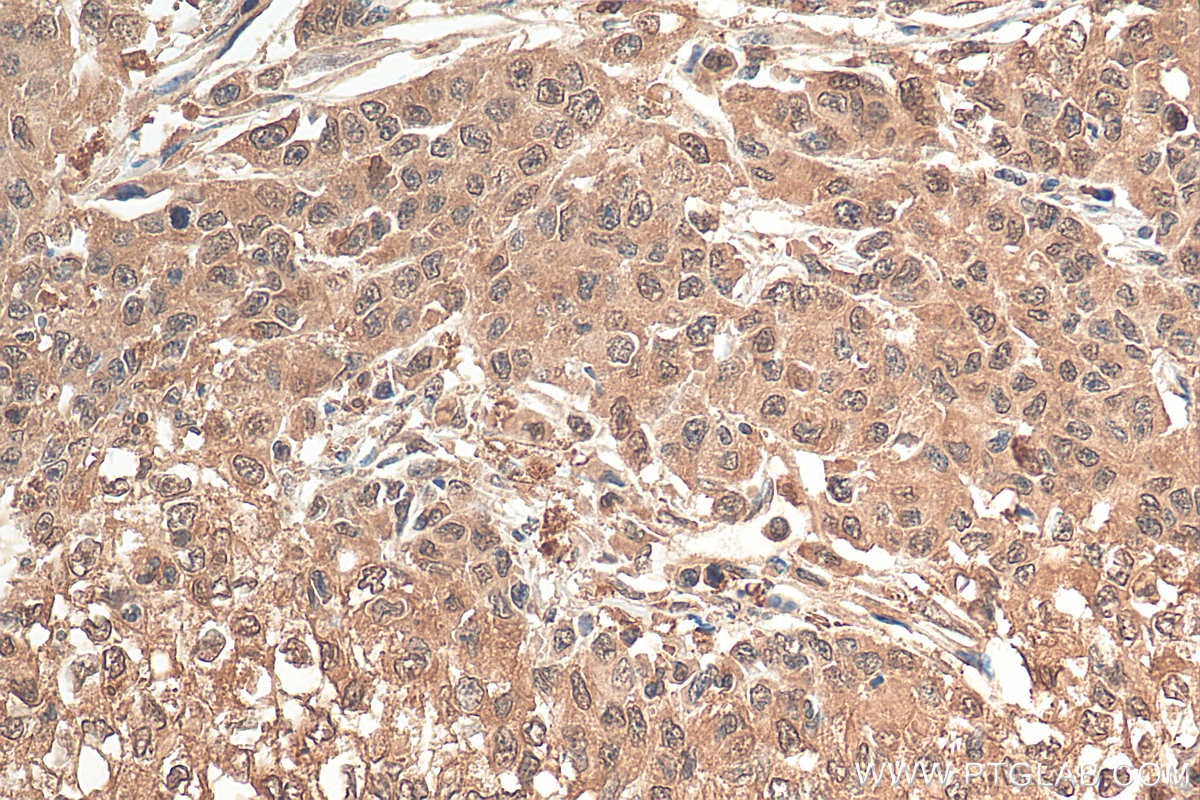 Immunohistochemistry (IHC) staining of human stomach cancer tissue using ENO1 Polyclonal antibody (11204-1-AP)
