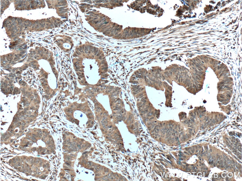 IHC staining of human colon cancer using 11204-1-AP