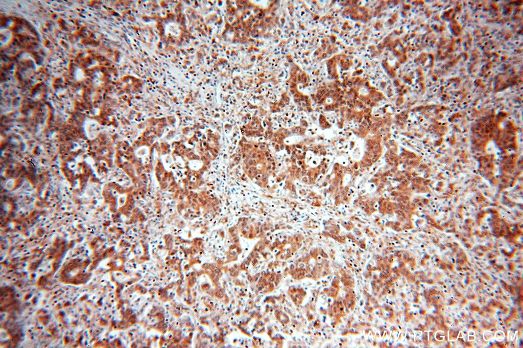 IHC staining of human stomach cancer using 11204-1-AP