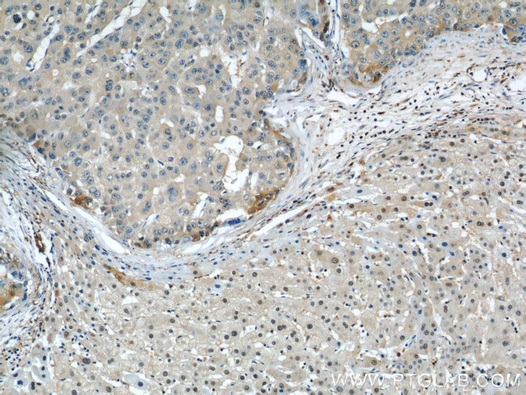 Immunohistochemistry (IHC) staining of human liver cancer tissue using ENO1 Polyclonal antibody (11204-1-AP)