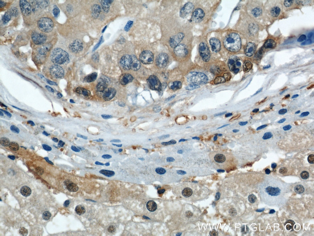 Immunohistochemistry (IHC) staining of human liver cancer tissue using ENO1 Polyclonal antibody (11204-1-AP)