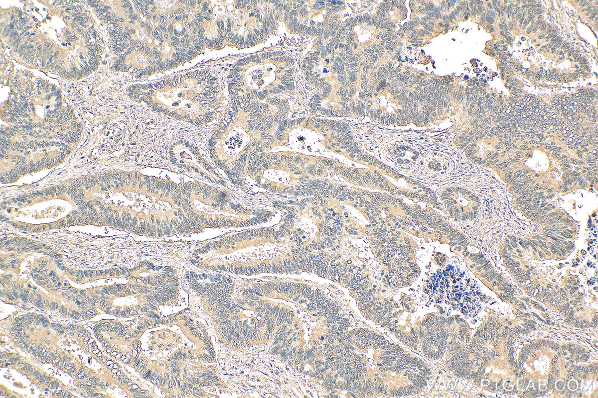 Immunohistochemistry (IHC) staining of human colon cancer tissue using ENO1 Recombinant antibody (81478-1-RR)