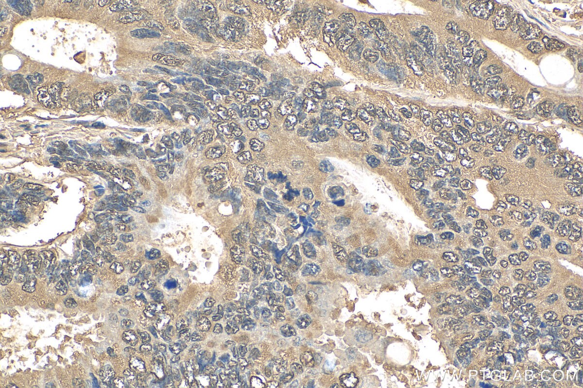 Immunohistochemistry (IHC) staining of human colon cancer tissue using ENO1 Recombinant antibody (81478-1-RR)