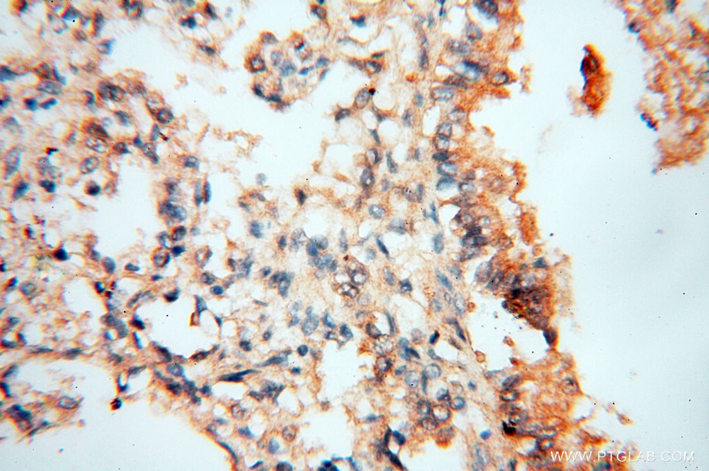 Immunohistochemistry (IHC) staining of human lung tissue using NSE Polyclonal antibody (10149-1-AP)