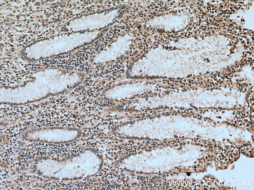 Immunohistochemistry (IHC) staining of human stomach cancer tissue using NSE/ENO2-specific Polyclonal antibody (55235-1-AP)