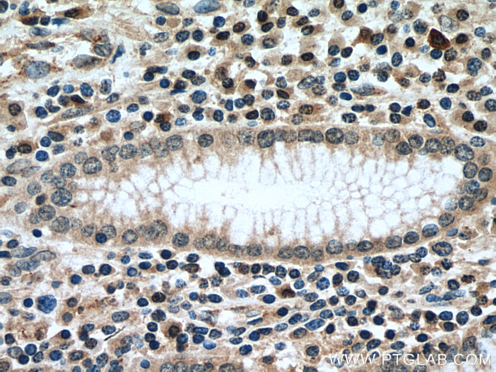 Immunohistochemistry (IHC) staining of human stomach cancer tissue using NSE/ENO2-specific Polyclonal antibody (55235-1-AP)