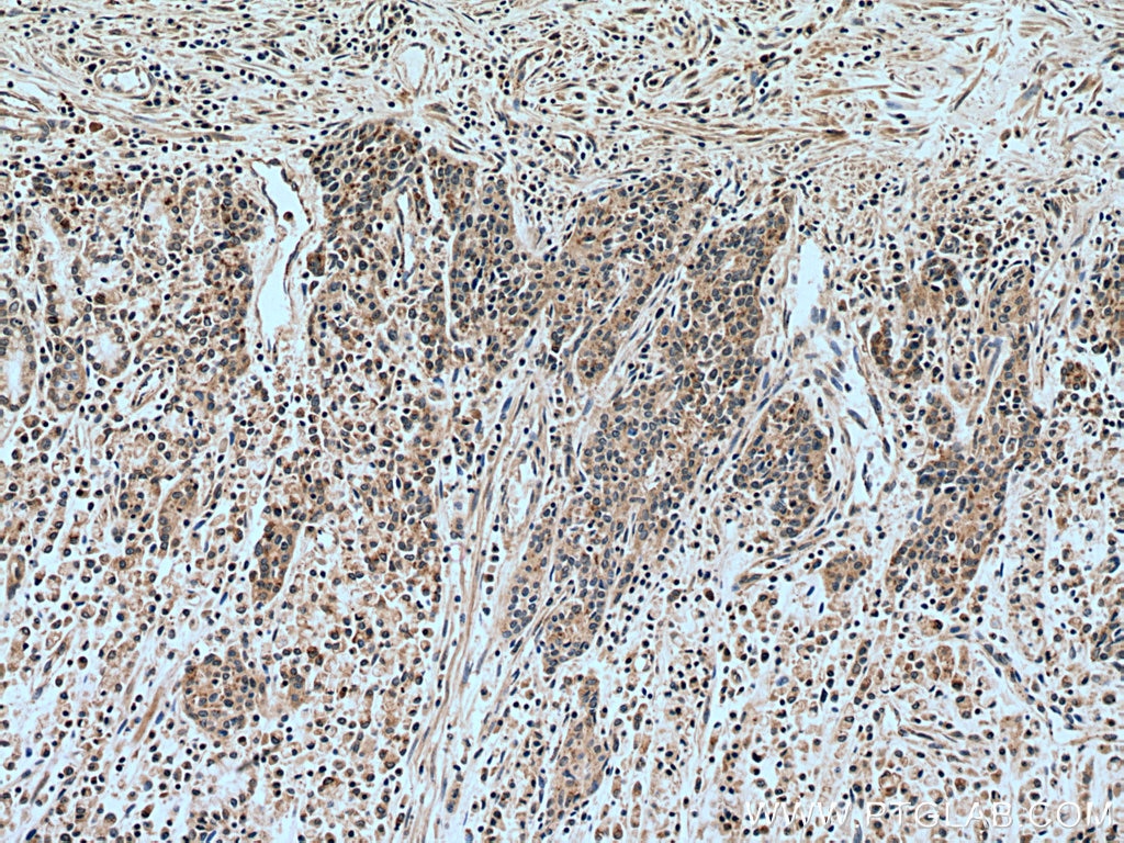 IHC staining of human stomach cancer using 55235-1-AP