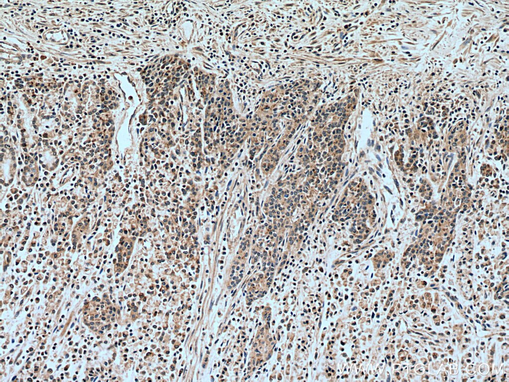 Immunohistochemistry (IHC) staining of human stomach cancer tissue using NSE/ENO2-specific Polyclonal antibody (55235-1-AP)