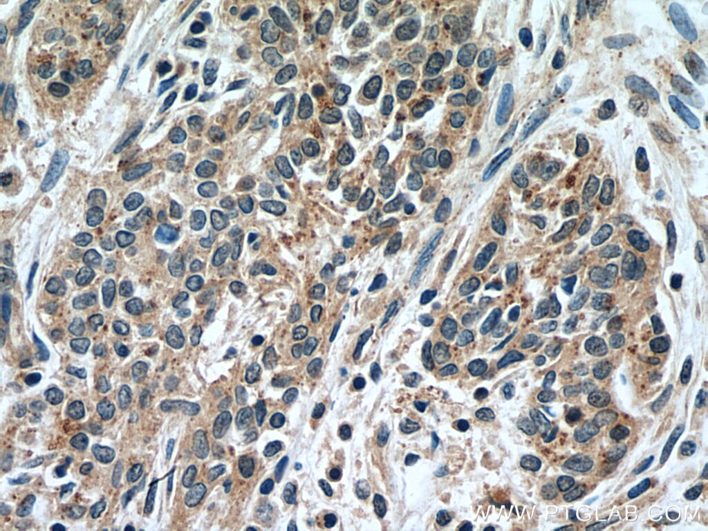 Immunohistochemistry (IHC) staining of human stomach cancer tissue using NSE/ENO2-specific Polyclonal antibody (55235-1-AP)