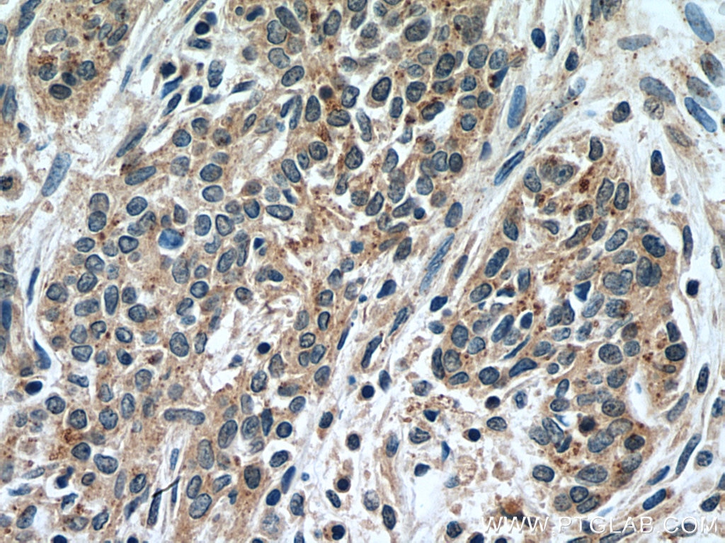 IHC staining of human stomach cancer using 55235-1-AP