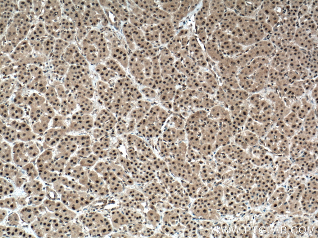 IHC staining of human liver cancer using 17731-1-AP
