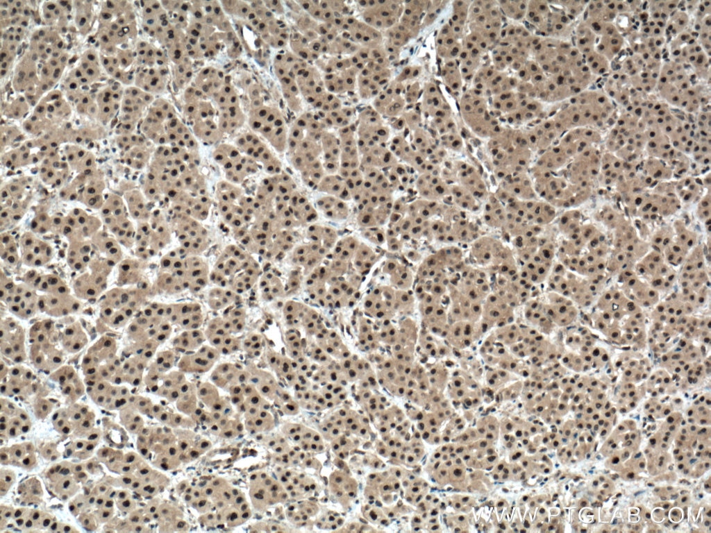 Immunohistochemistry (IHC) staining of human liver cancer tissue using ENOPH1 Polyclonal antibody (17731-1-AP)