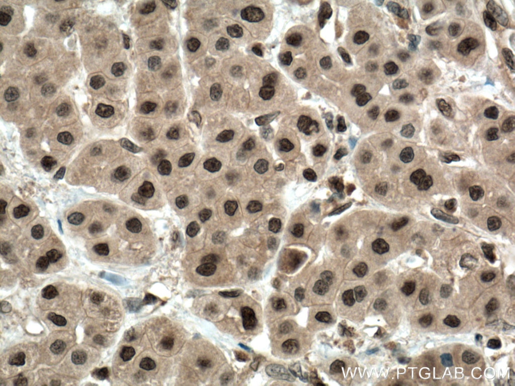 Immunohistochemistry (IHC) staining of human liver cancer tissue using ENOPH1 Polyclonal antibody (17731-1-AP)