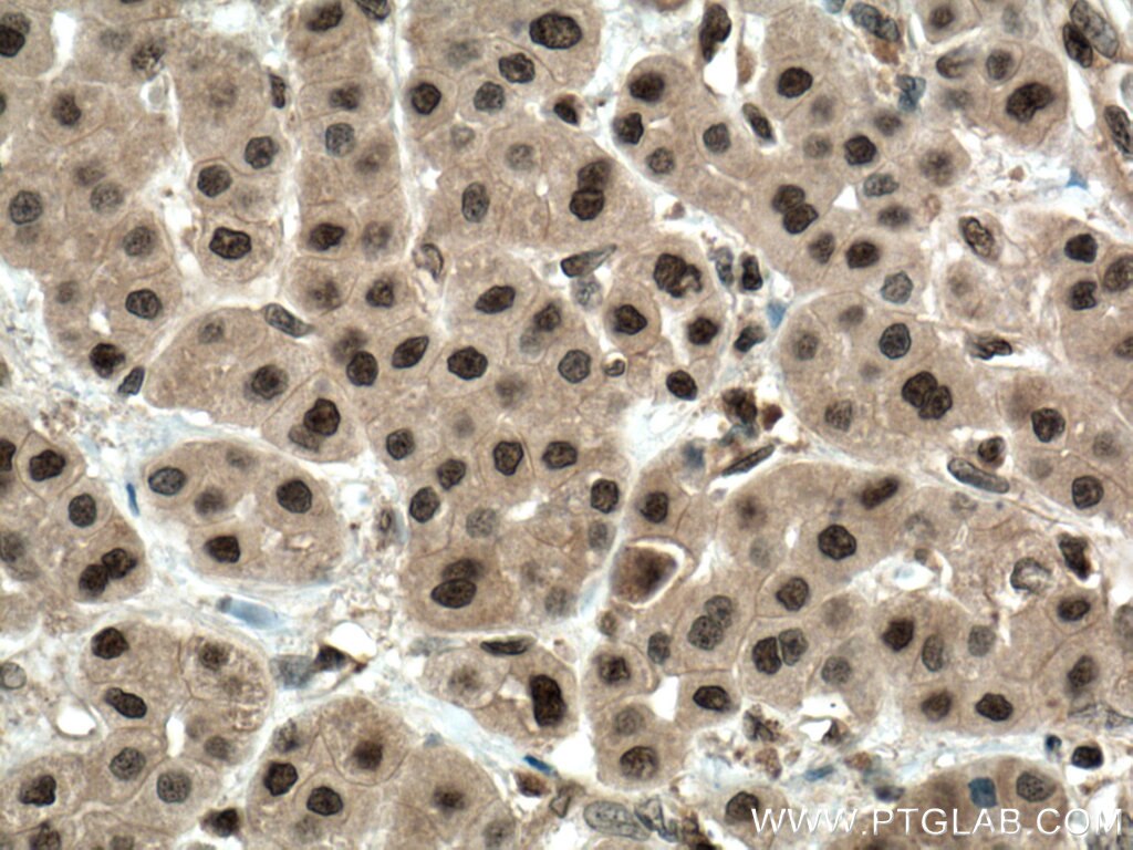 IHC staining of human liver cancer using 17731-1-AP