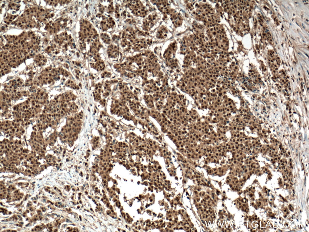 Immunohistochemistry (IHC) staining of human colon cancer tissue using ENOPH1 Polyclonal antibody (17731-1-AP)