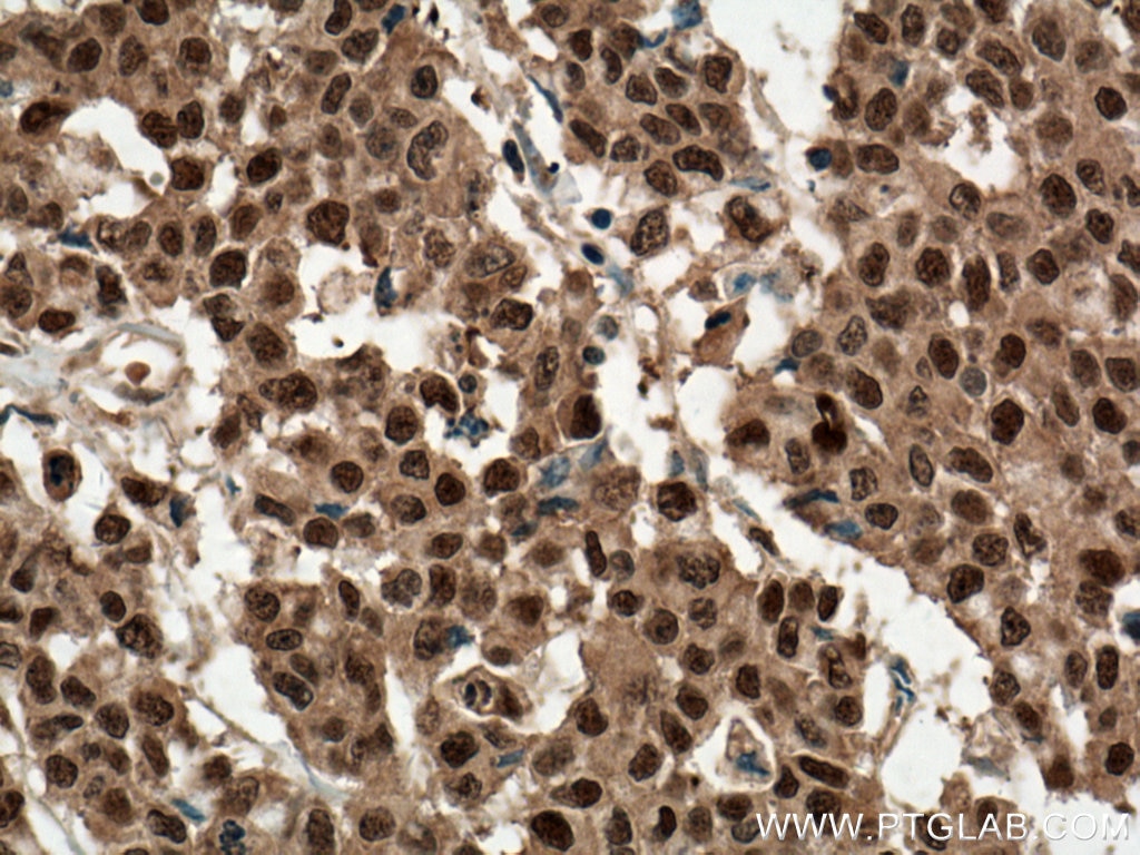 Immunohistochemistry (IHC) staining of human colon cancer tissue using ENOPH1 Polyclonal antibody (17731-1-AP)