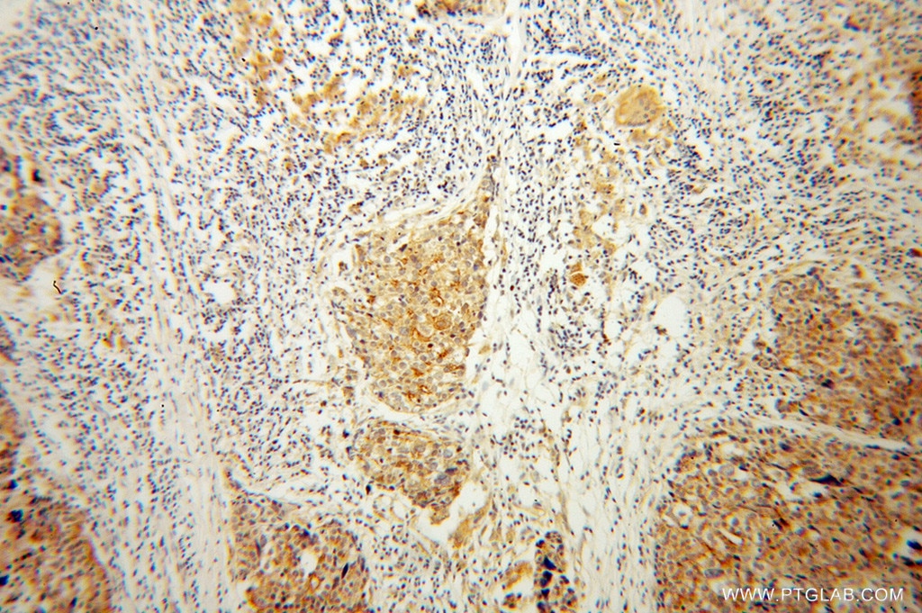 Immunohistochemistry (IHC) staining of human ovary tumor tissue using ENOX2 Polyclonal antibody (10423-1-AP)