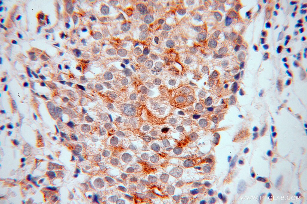 Immunohistochemistry (IHC) staining of human ovary tumor tissue using ENOX2 Polyclonal antibody (10423-1-AP)