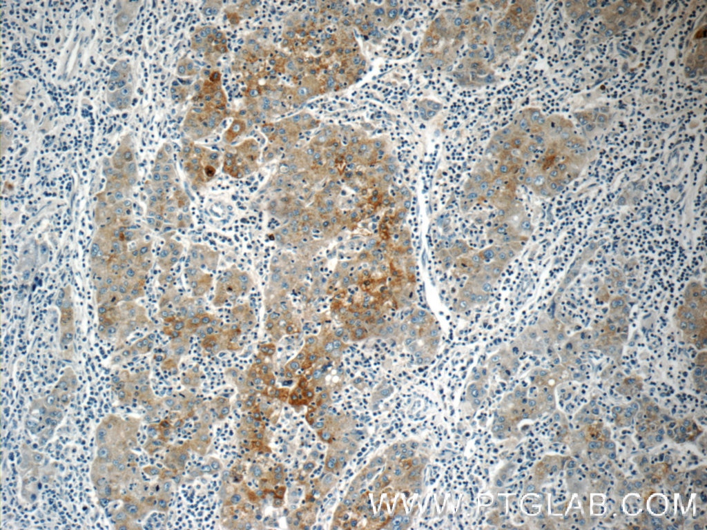 Immunohistochemistry (IHC) staining of human liver cancer tissue using Autotaxin Polyclonal antibody (14243-1-AP)