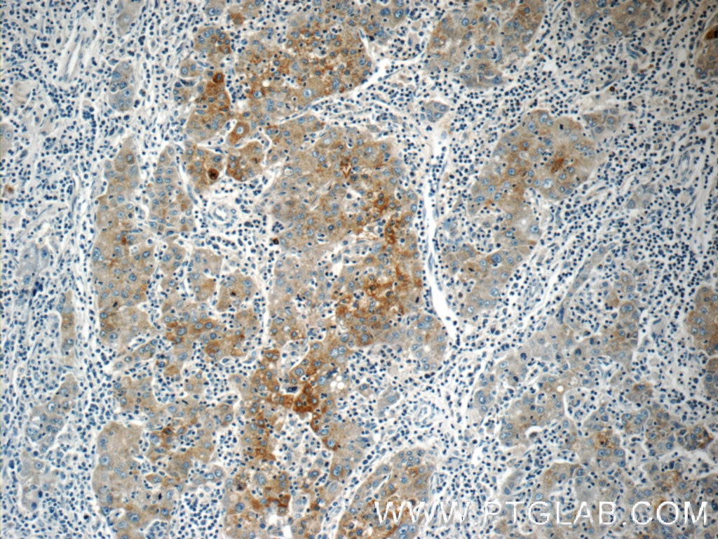 Immunohistochemistry (IHC) staining of human liver cancer tissue using Autotaxin Polyclonal antibody (14243-1-AP)